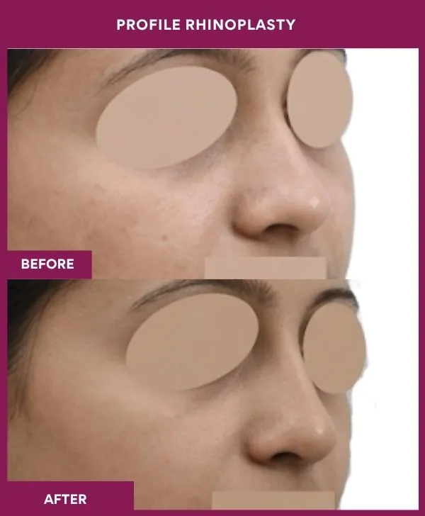 profile-rhinoplasty-before-after-results-mumbai-india-patient05-side-right
