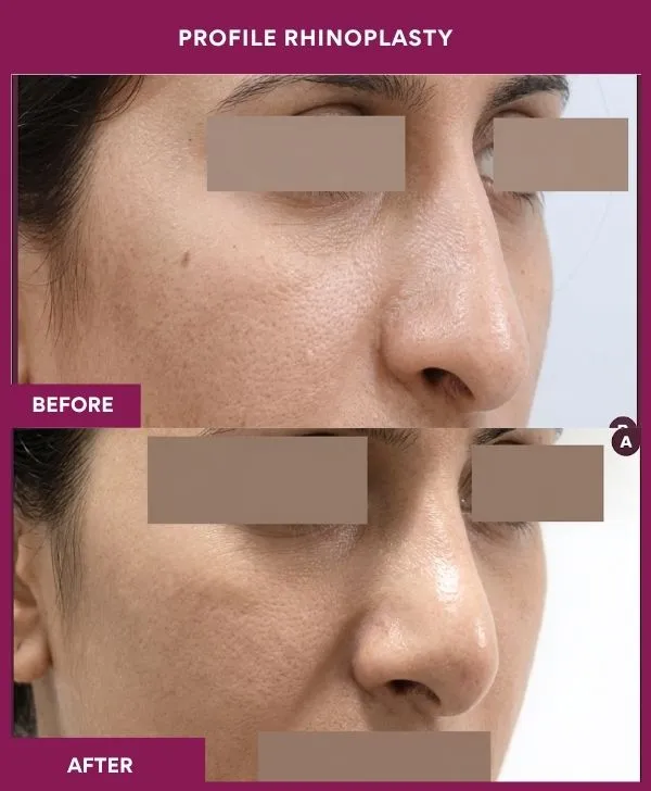 profile-rhinoplasty-before-after-results-mumbai-india-patient06-side-right