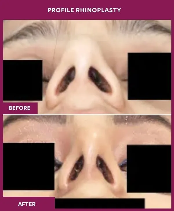 profile-rhinoplasty-before-after-results-mumbai-india-patient07-front
