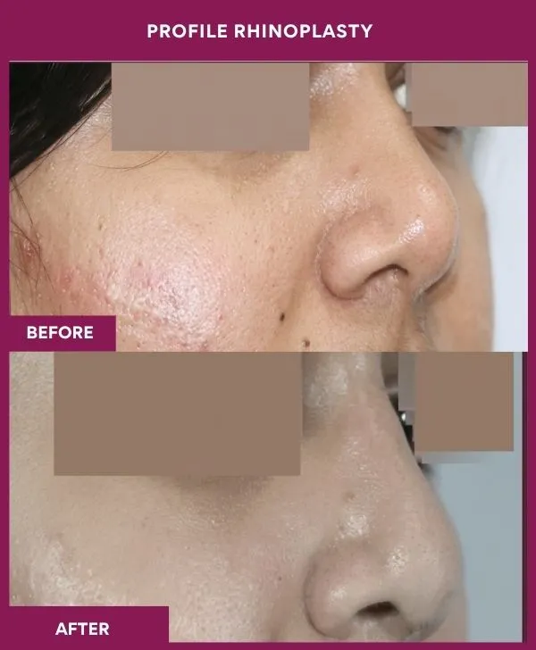 profile-rhinoplasty-before-after-results-mumbai-india-patient08-side-right