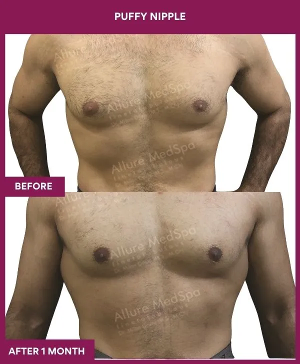 puffy-nipple-surgery-before-after-results-mumbai-india-patient01-front
