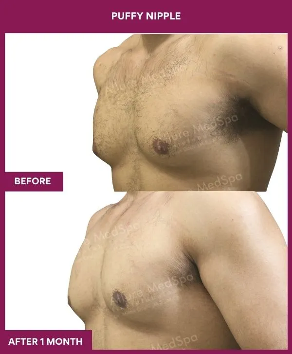 puffy-nipple-surgery-before-after-results-mumbai-india-patient01-side-left