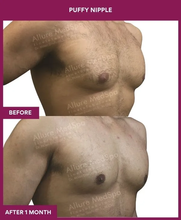 puffy-nipple-surgery-before-after-results-mumbai-india-patient01-side-right