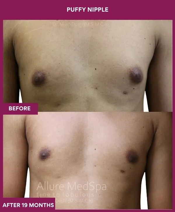 puffy-nipple-surgery-before-after-results-mumbai-india-patient02-front