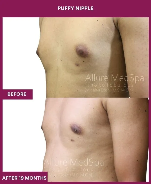 puffy-nipple-surgery-before-after-results-mumbai-india-patient02-side-left