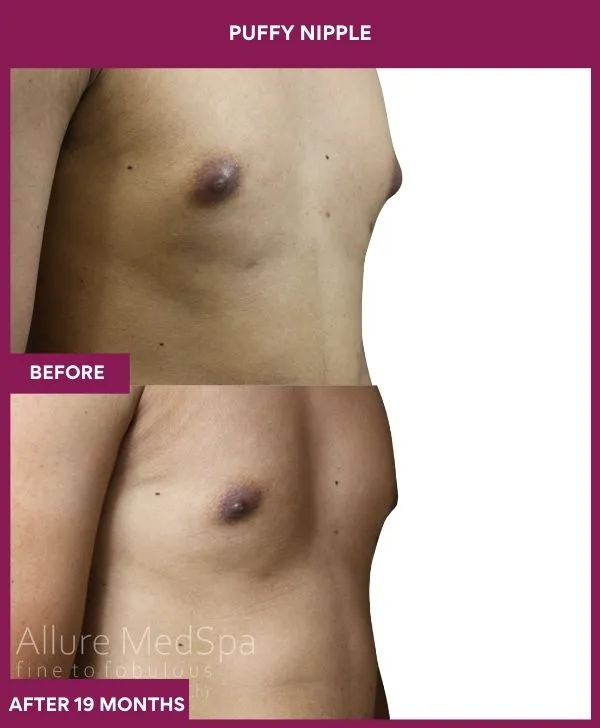 puffy-nipple-surgery-before-after-results-mumbai-india-patient02-side-right
