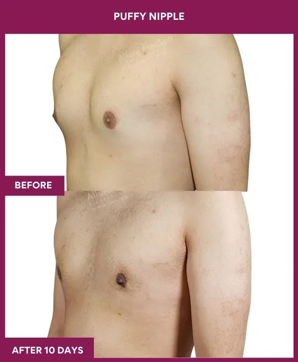 puffy-nipple-surgery-before-after-results-mumbai-india-patient03-side-left