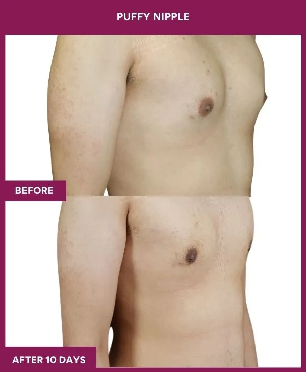 puffy-nipple-surgery-before-after-results-mumbai-india-patient03-side-right