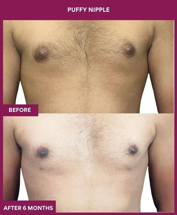 puffy-nipple-surgery-before-after-results-mumbai-india-patient04-front