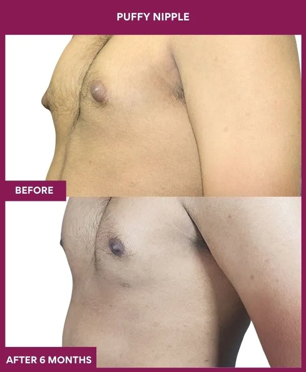 puffy-nipple-surgery-before-after-results-mumbai-india-patient04-side-left