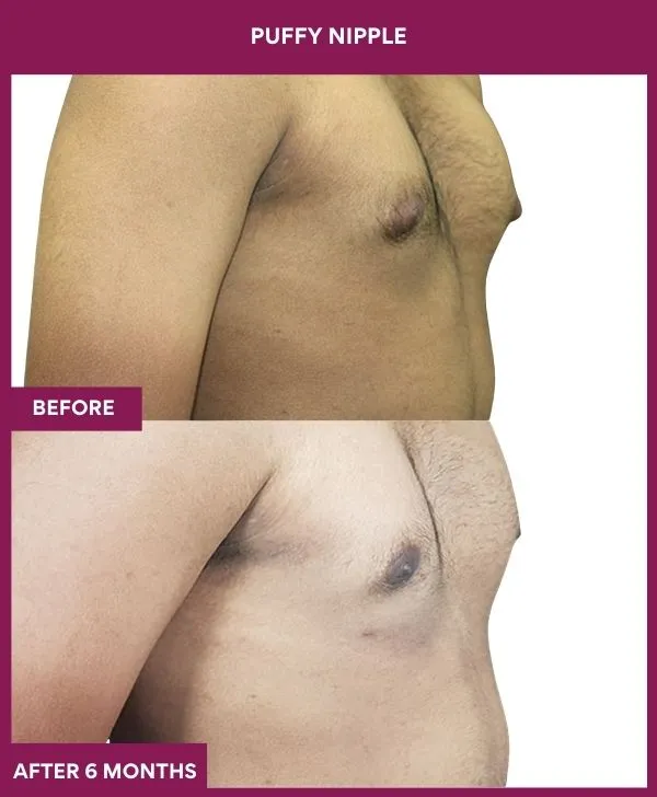 puffy-nipple-surgery-before-after-results-mumbai-india-patient04-side-right