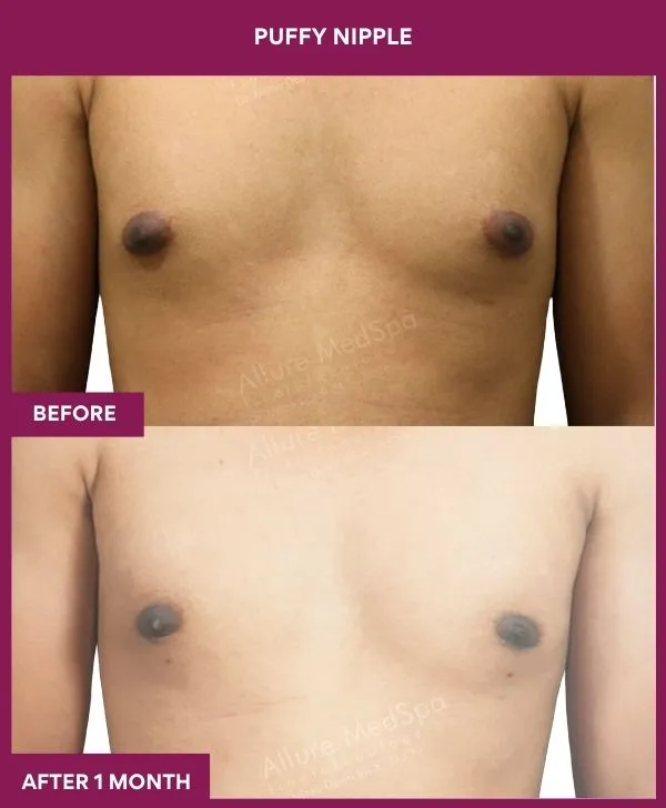 puffy-nipple-surgery-before-after-results-mumbai-india-patient05-front