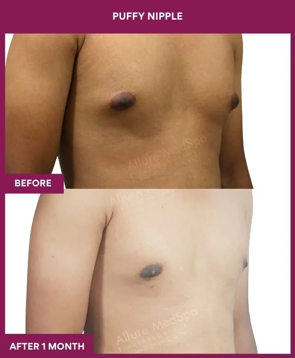 puffy-nipple-surgery-before-after-results-mumbai-india-patient05-side-right