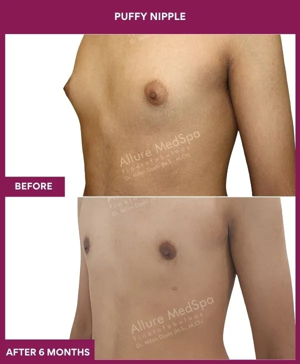 puffy-nipple-surgery-before-after-results-mumbai-india-patient06-front-left