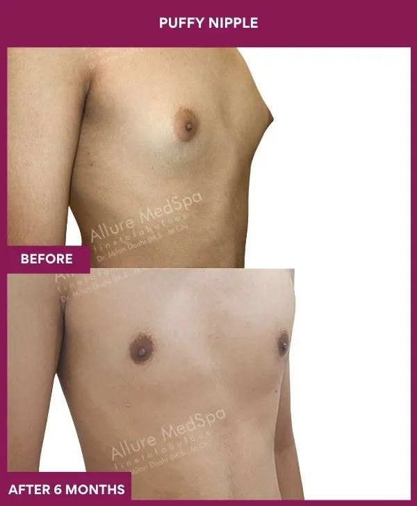 puffy-nipple-surgery-before-after-results-mumbai-india-patient06-side-right