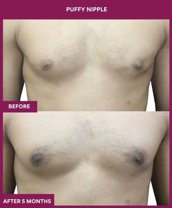 puffy-nipple-surgery-before-after-results-mumbai-india-patient07-front