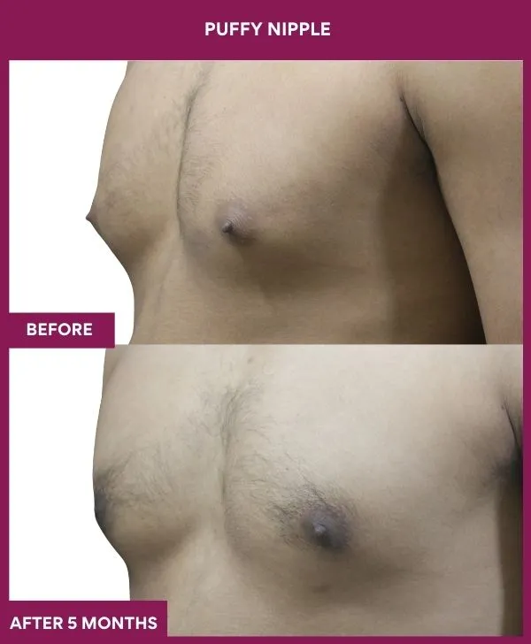 puffy-nipple-surgery-before-after-results-mumbai-india-patient07-side-lrft