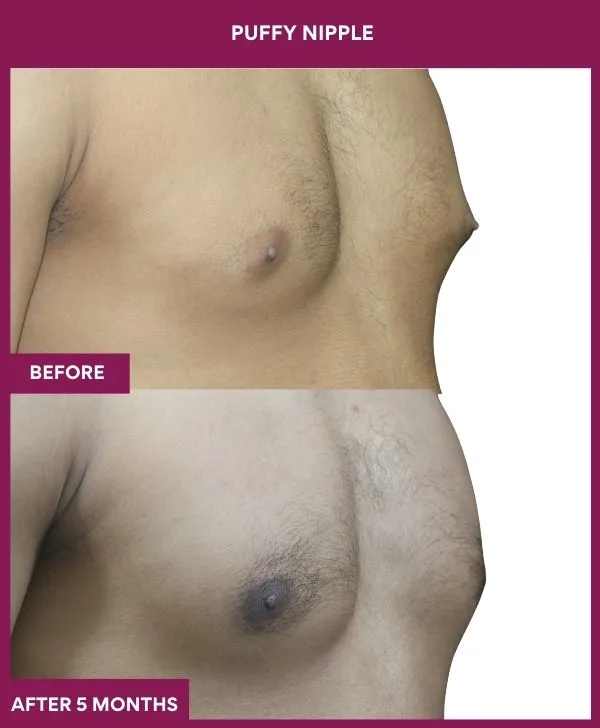 puffy-nipple-surgery-before-after-results-mumbai-india-patient07-side-right