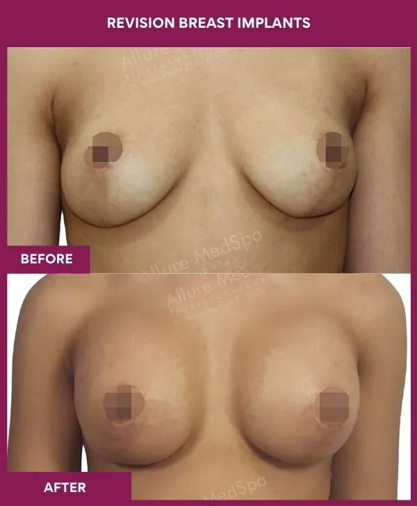 revision-breast-implant-before-after-results-mumbai-india-patient01-front