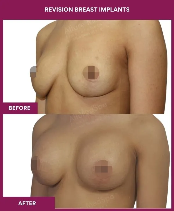 revision-breast-implant-before-after-results-mumbai-india-patient01-side-left