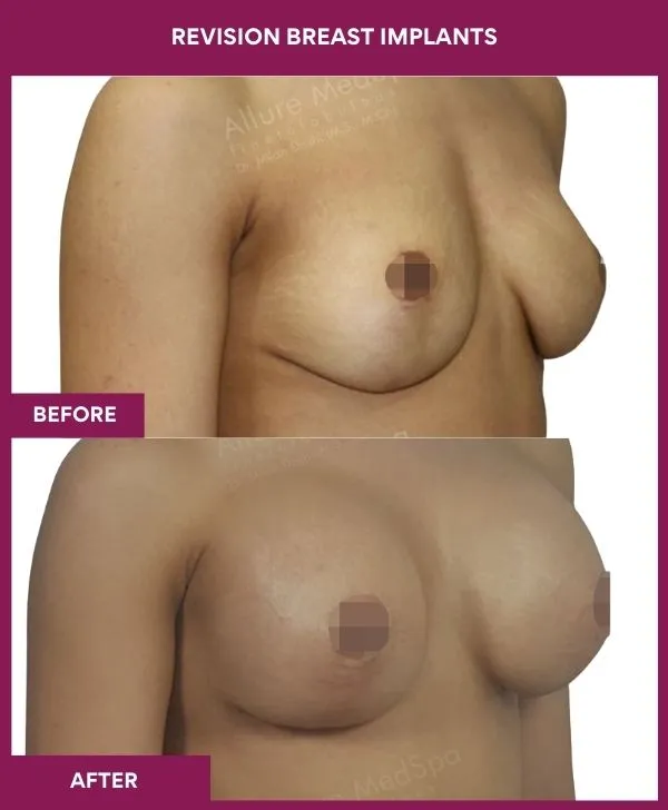 revision-breast-implant-before-after-results-mumbai-india-patient01-side-right