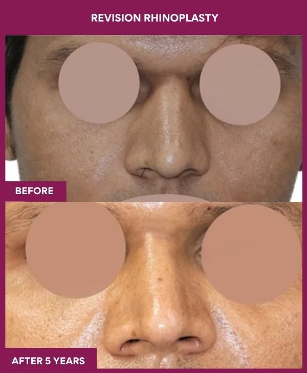 revision-rhinoplasty-surgery-before-after-results-mumbai-india-patient01-front