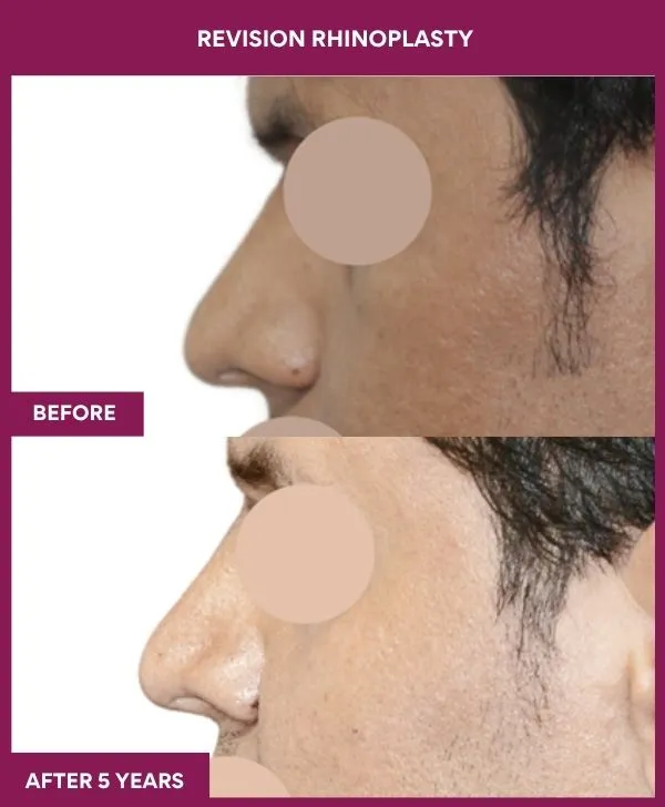 revision-rhinoplasty-surgery-before-after-results-mumbai-india-patient01-side-left