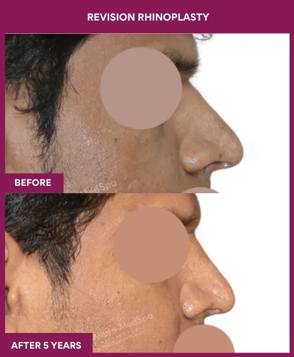 revision-rhinoplasty-surgery-before-after-results-mumbai-india-patient01-side-right