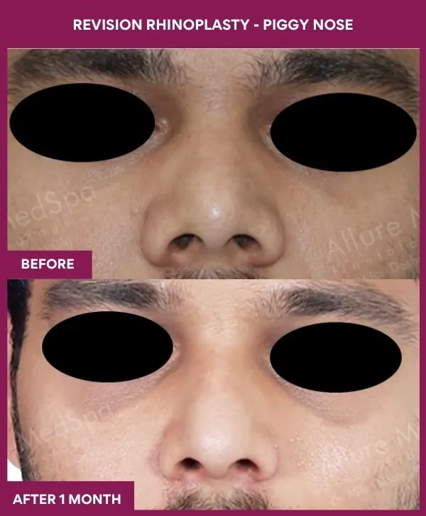 revision-rhinoplasty-surgery-before-after-results-mumbai-india-patient02-front