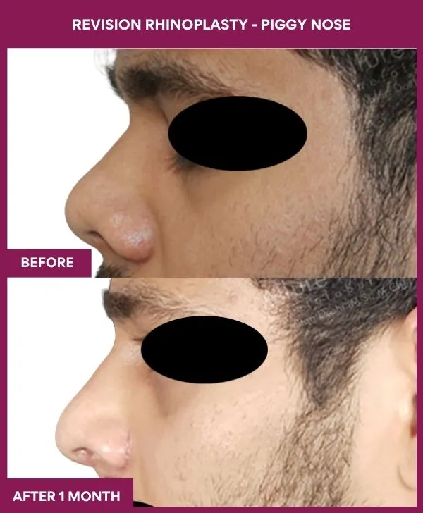 revision-rhinoplasty-surgery-before-after-results-mumbai-india-patient02-side-left