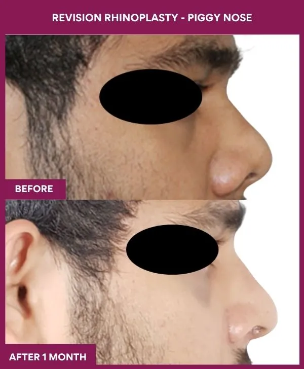 revision-rhinoplasty-surgery-before-after-results-mumbai-india-patient02-side-right