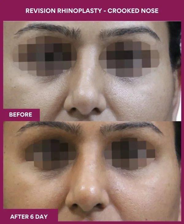 revision-rhinoplasty-surgery-before-after-results-mumbai-india-patient03-front