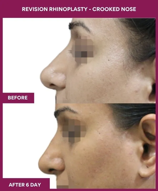revision-rhinoplasty-surgery-before-after-results-mumbai-india-patient03-side-left