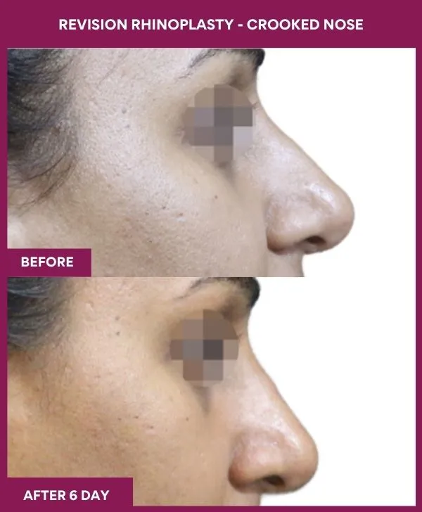 revision-rhinoplasty-surgery-before-after-results-mumbai-india-patient03-side-right