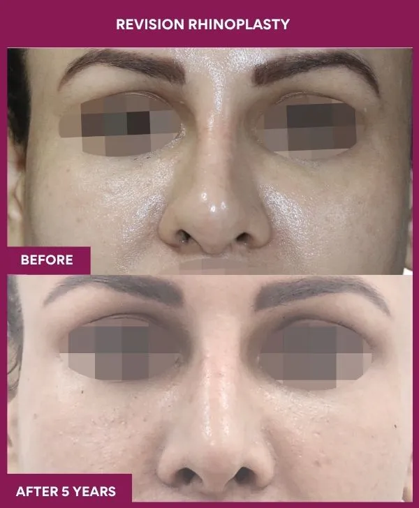 revision-rhinoplasty-surgery-before-after-results-mumbai-india-patient04-front