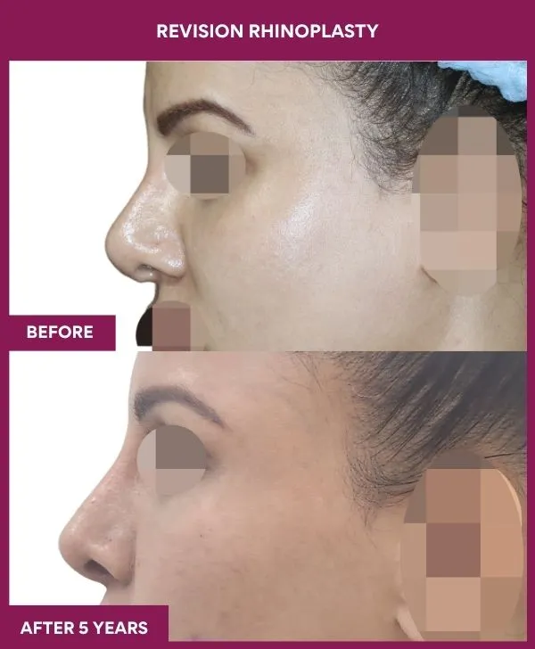 revision-rhinoplasty-surgery-before-after-results-mumbai-india-patient04-side-left