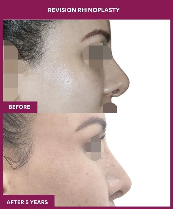 revision-rhinoplasty-surgery-before-after-results-mumbai-india-patient04-side-right