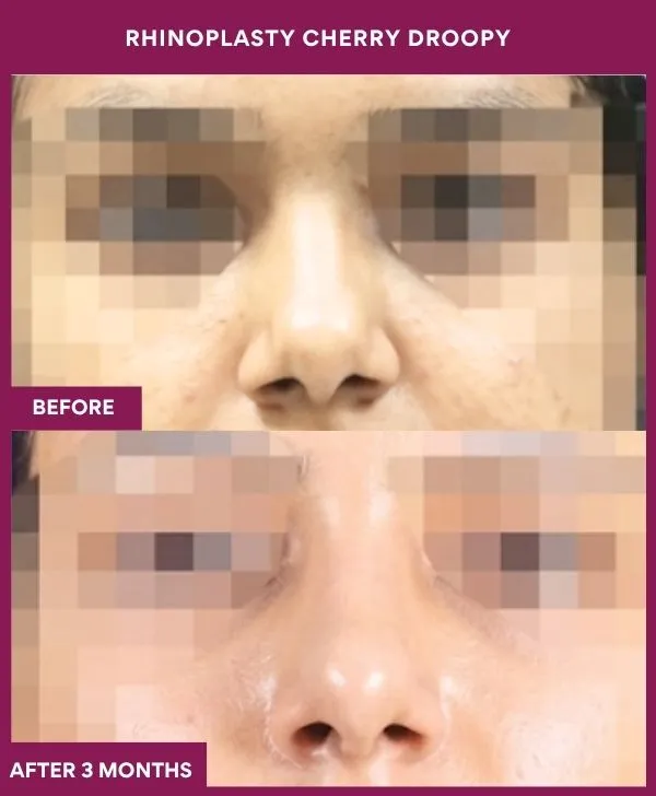 rhinoplasty-cherry-droopy-surgery-before-after-results-mumbai-india-patient01-front