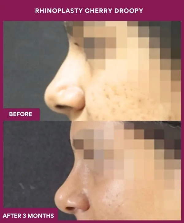 rhinoplasty-cherry-droopy-surgery-before-after-results-mumbai-india-patient01-side-left