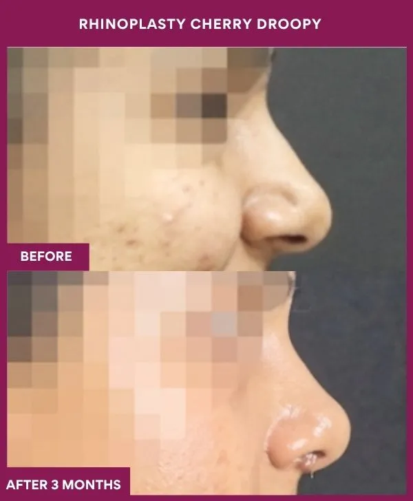 rhinoplasty-cherry-droopy-surgery-before-after-results-mumbai-india-patient01-side-right