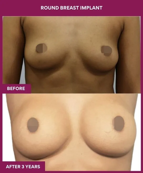 round-breast-implants-before-after-results-mumbai-india-patient01-front