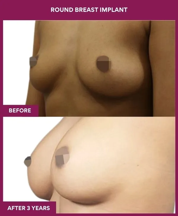 round-breast-implants-before-after-results-mumbai-india-patient01-side-left