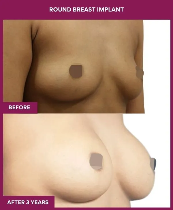 round-breast-implants-before-after-results-mumbai-india-patient01-side-right