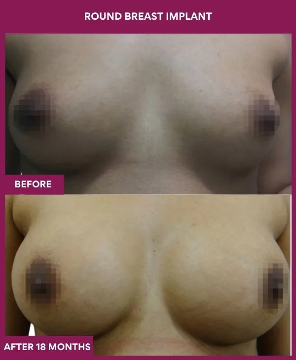 round-breast-implants-before-after-results-mumbai-india-patient02-front