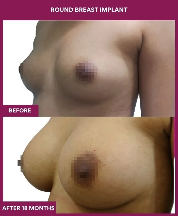 round-breast-implants-before-after-results-mumbai-india-patient02-side-left