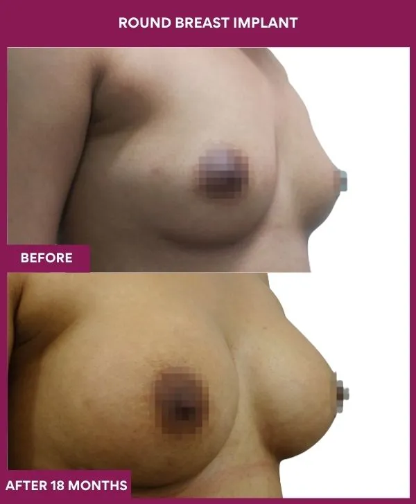 round-breast-implants-before-after-results-mumbai-india-patient02-side-right