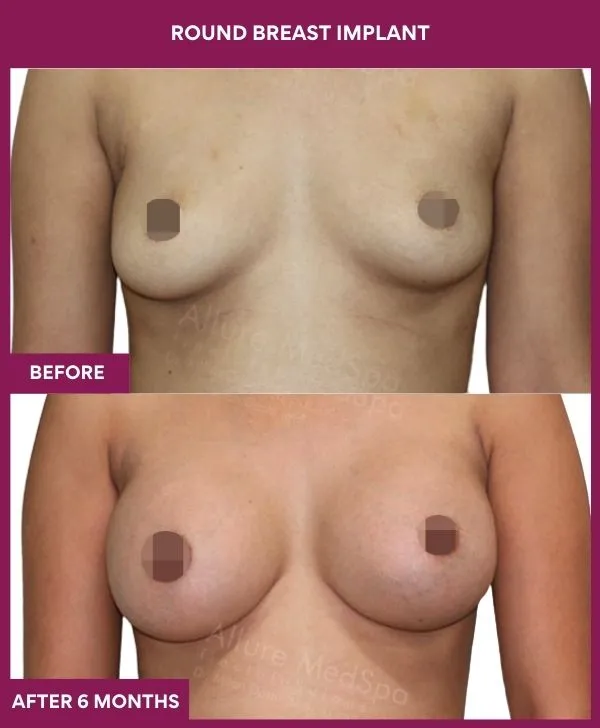 round-breast-implants-before-after-results-mumbai-india-patient03-front