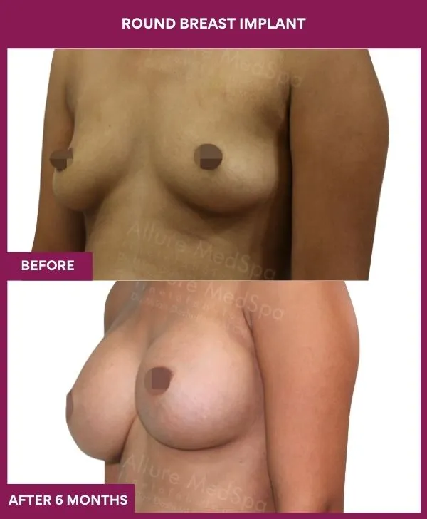 round-breast-implants-before-after-results-mumbai-indiapatient03-side-left
