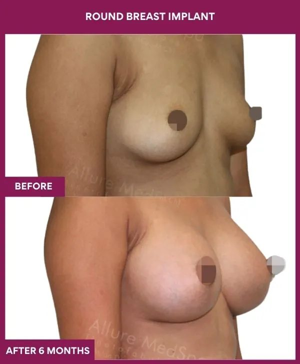 round-breast-implants-before-after-results-mumbai-india-patient03-side-right
