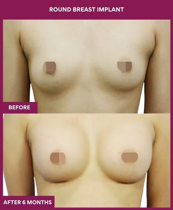 round-breast-implants-before-after-results-mumbai-india-patient04-front